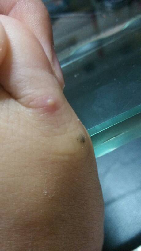 脚上起小水泡还很痒是什么原因（脚上起小水泡很痒是怎么回事百度百科）